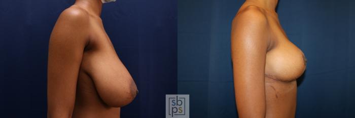 Before & After Breast Reduction Case 659 Right Side View in Torrance, CA
