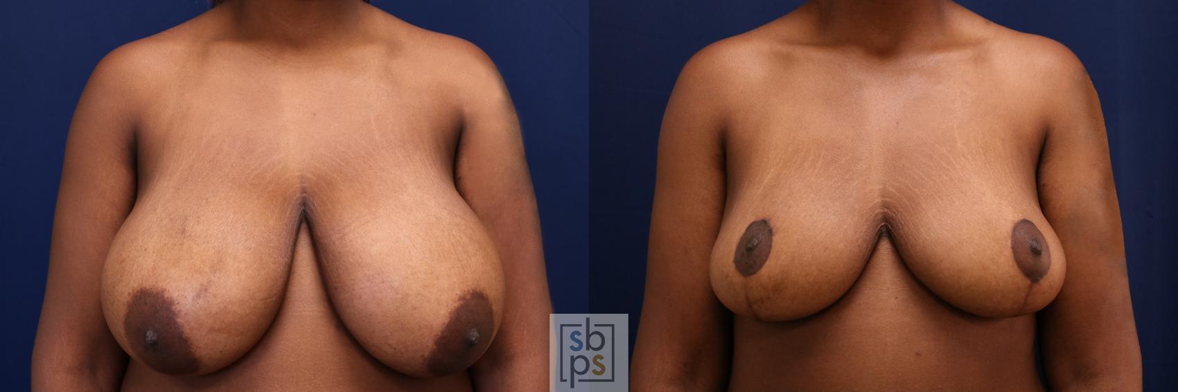 Before & After Breast Reduction Case 661 Front View in Torrance, CA