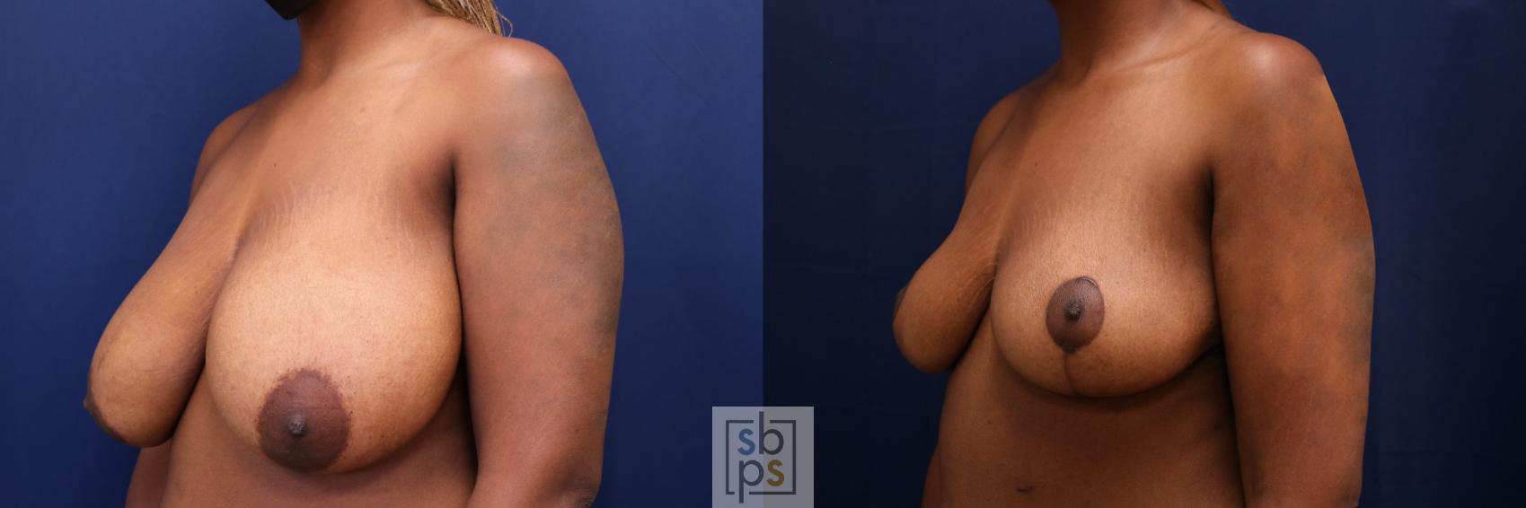 Before & After Breast Reduction Case 661 Left Oblique View in Torrance & Los Angeles, CA, CA