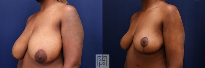 Before & After Breast Reduction Case 661 Left Oblique View in Torrance, CA