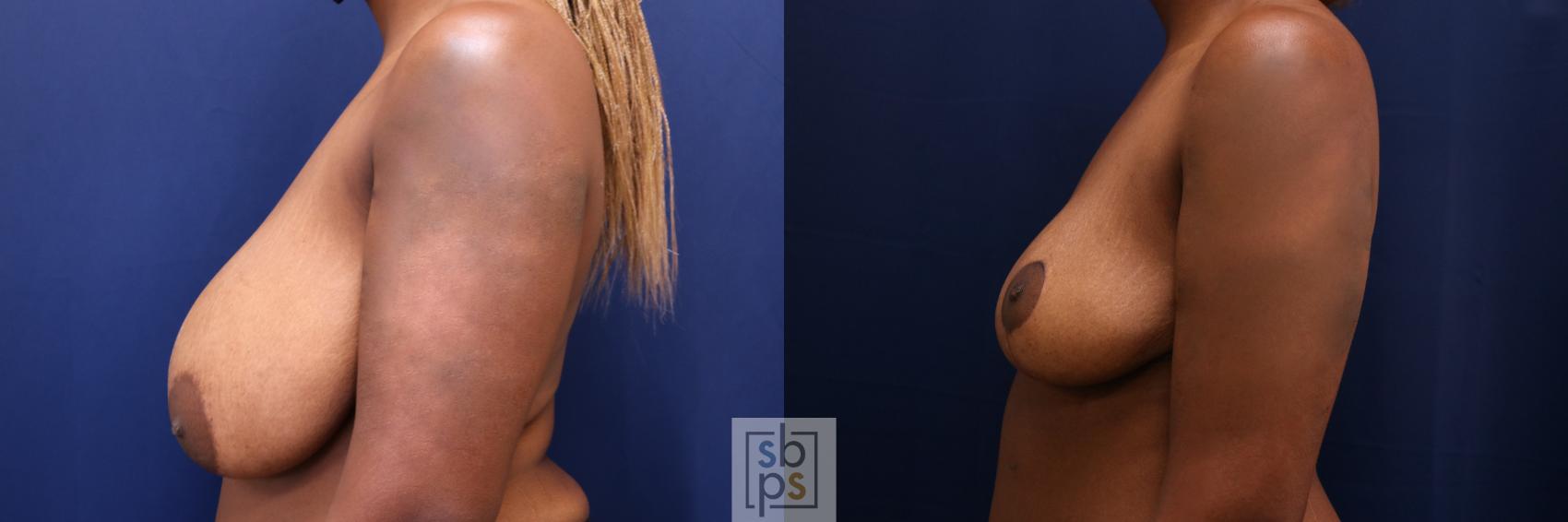 Before & After Breast Reduction Case 661 Left Side View in Torrance & Los Angeles, CA, CA