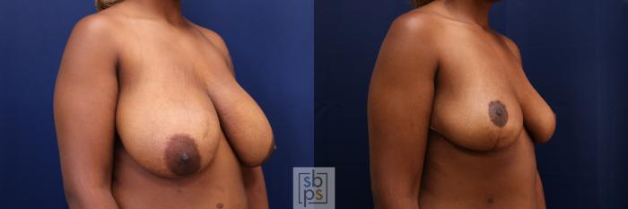 Before & After Breast Reduction Case 661 Right Oblique View in Torrance, CA