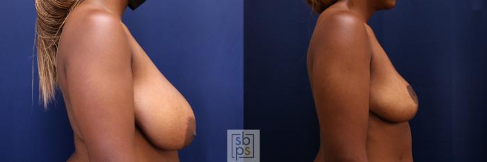 Before & After Breast Reduction Case 661 Right Side View in Torrance, CA