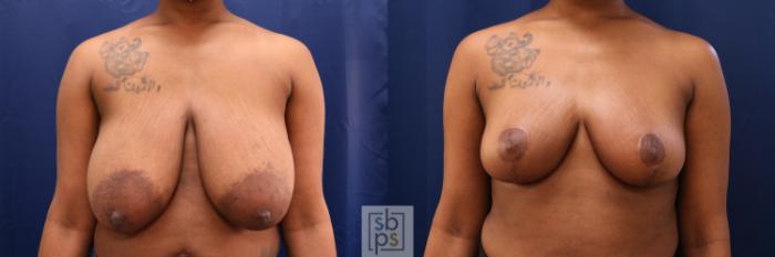 Before & After Breast Reduction Case 670 Front View in Torrance, CA