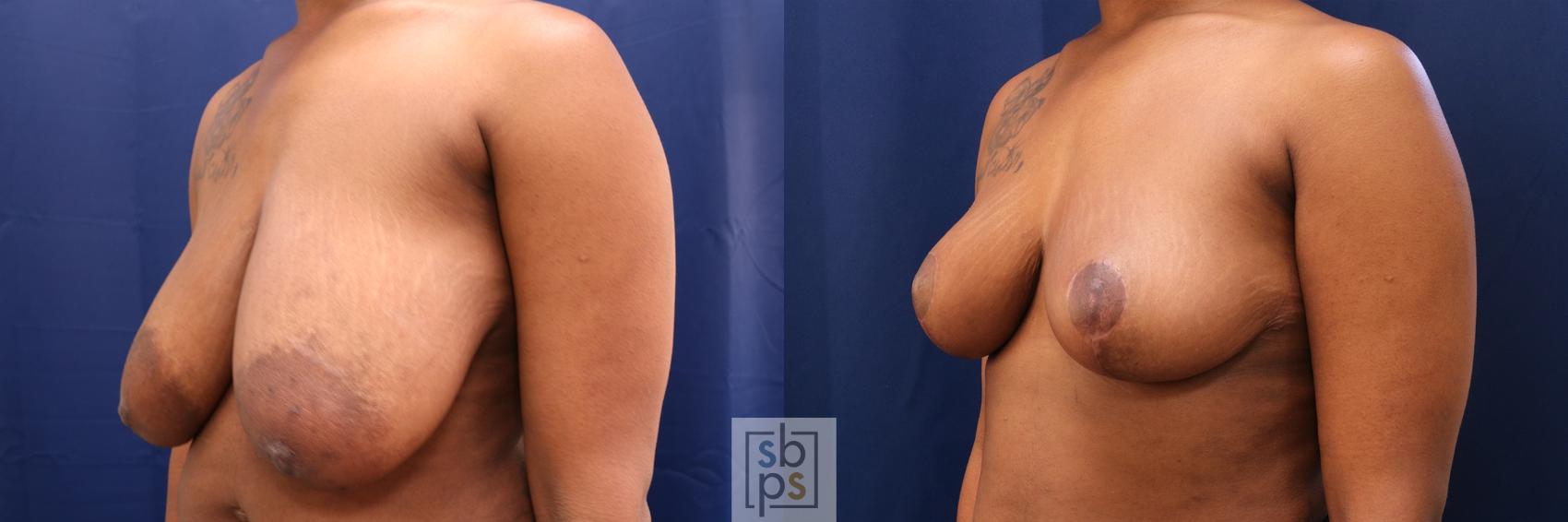 Before & After Breast Reduction Case 670 Left Oblique View in Torrance & Los Angeles, CA, CA