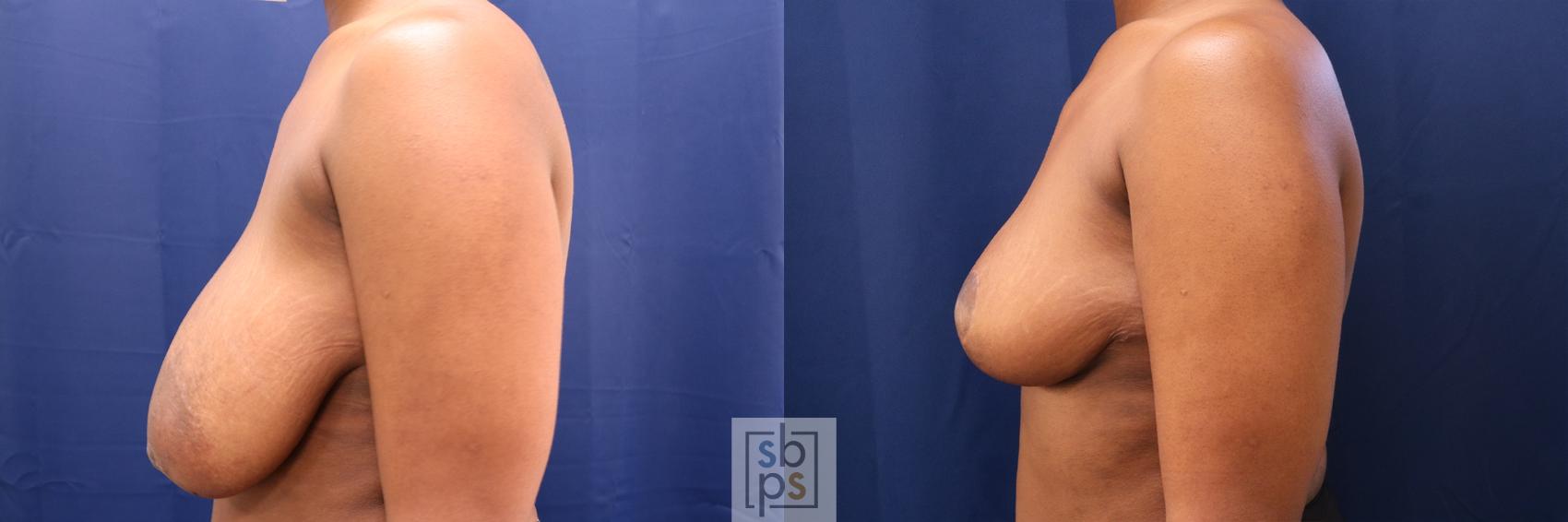 Before & After Breast Reduction Case 670 Left Side View in Torrance & Los Angeles, CA, CA