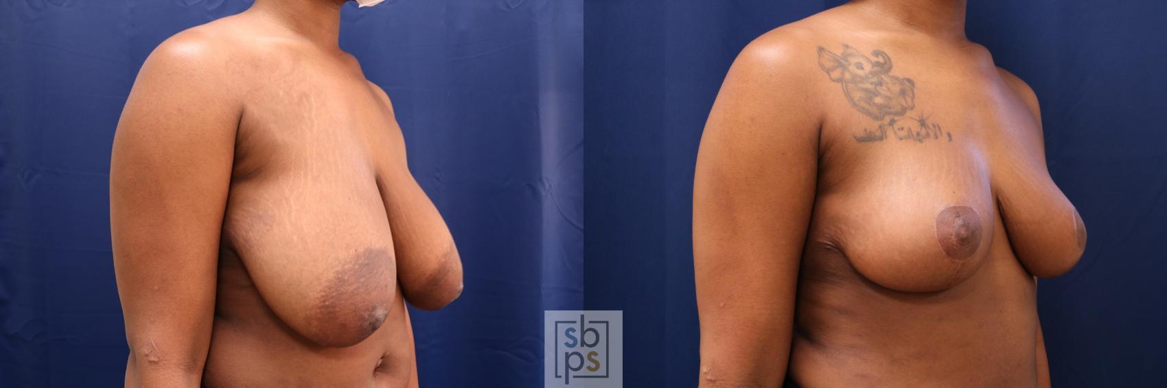 Before & After Breast Reduction Case 670 Right Oblique View in Torrance & Los Angeles, CA, CA
