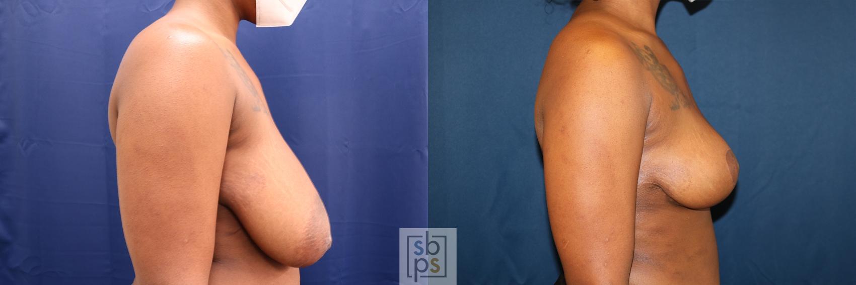 Before & After Breast Reduction Case 670 Right Side View in Torrance & Los Angeles, CA, CA