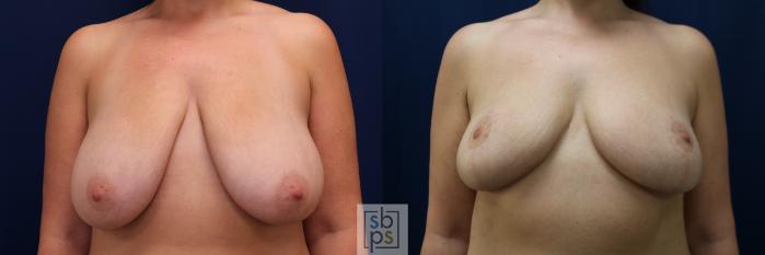 Before & After Breast Reduction Case 673 Front View in Torrance, CA