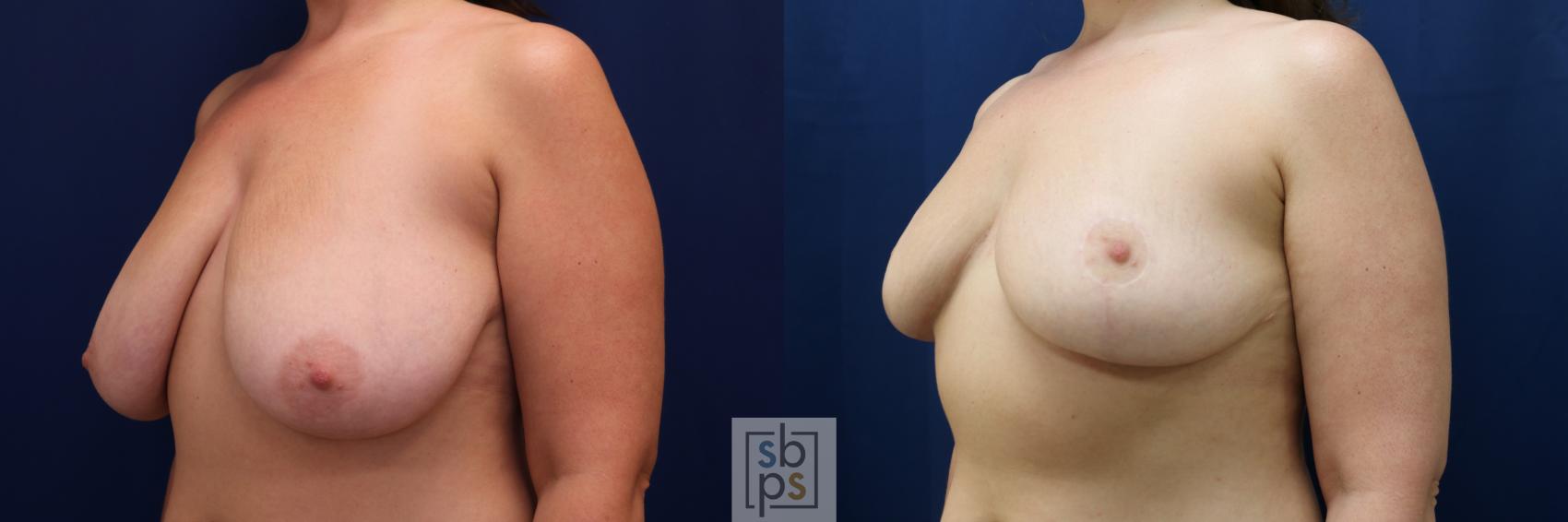 Before & After Breast Reduction Case 673 Left Oblique View in Torrance & Los Angeles, CA, CA