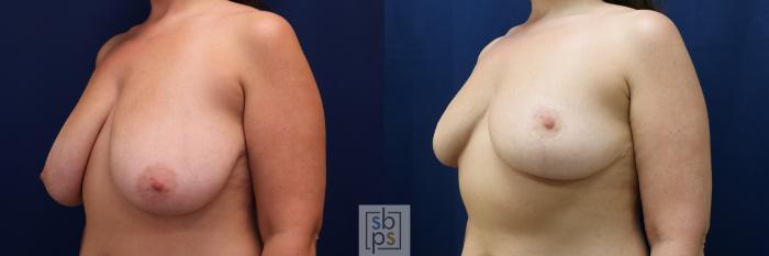 Before & After Breast Reduction Case 673 Left Oblique View in Torrance, CA
