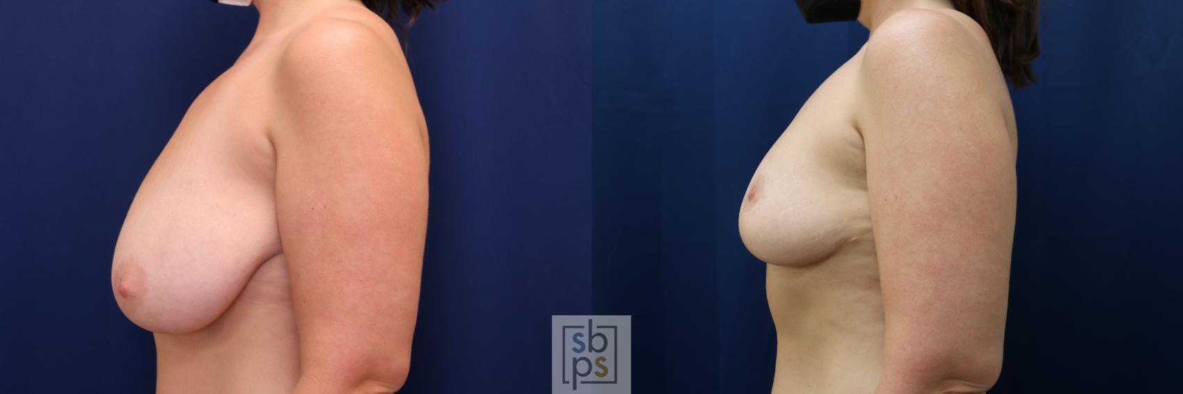 Before & After Breast Reduction Case 673 Left Side View in Torrance & Los Angeles, CA, CA
