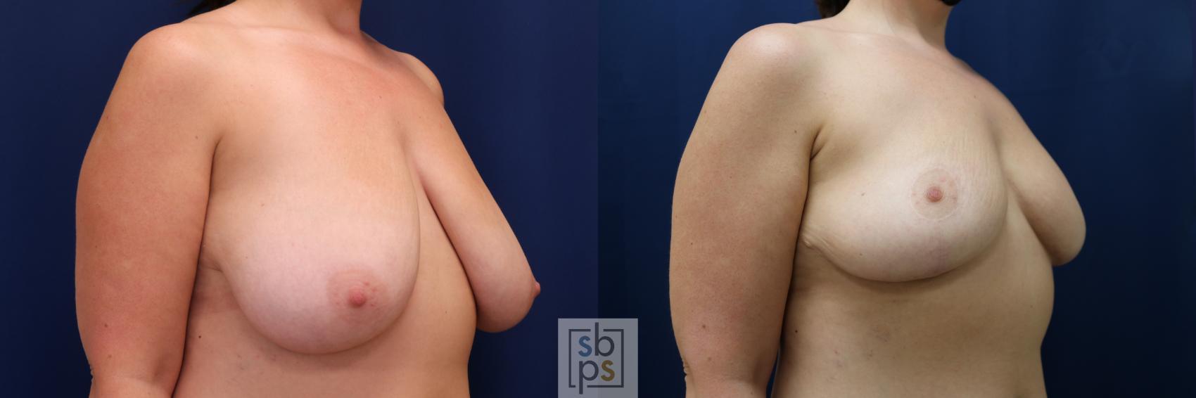 Before & After Breast Reduction Case 673 Right Oblique View in Torrance & Los Angeles, CA, CA