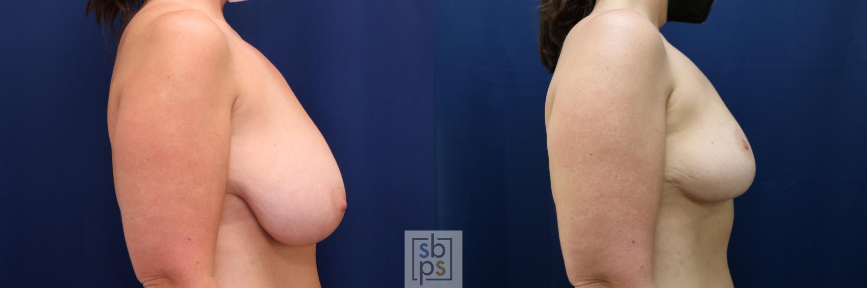 Before & After Breast Reduction Case 673 Right Side View in Torrance & Los Angeles, CA, CA