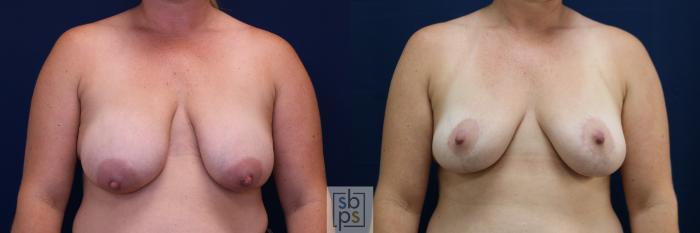 Before & After Breast Reduction Case 674 Front View in Torrance, CA