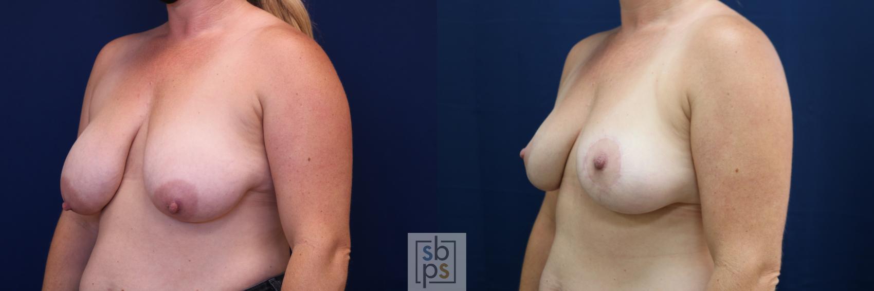 Before & After Breast Reduction Case 674 Left Oblique View in Los Angeles & Torrance, CA, CA