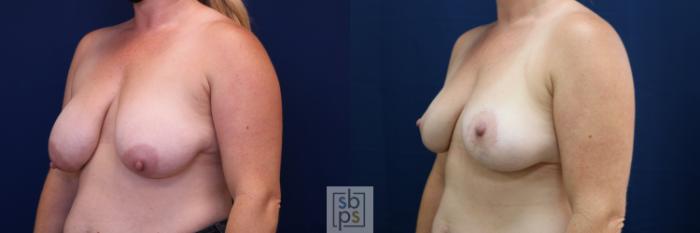 Before & After Breast Reduction Case 674 Left Oblique View in Torrance, CA