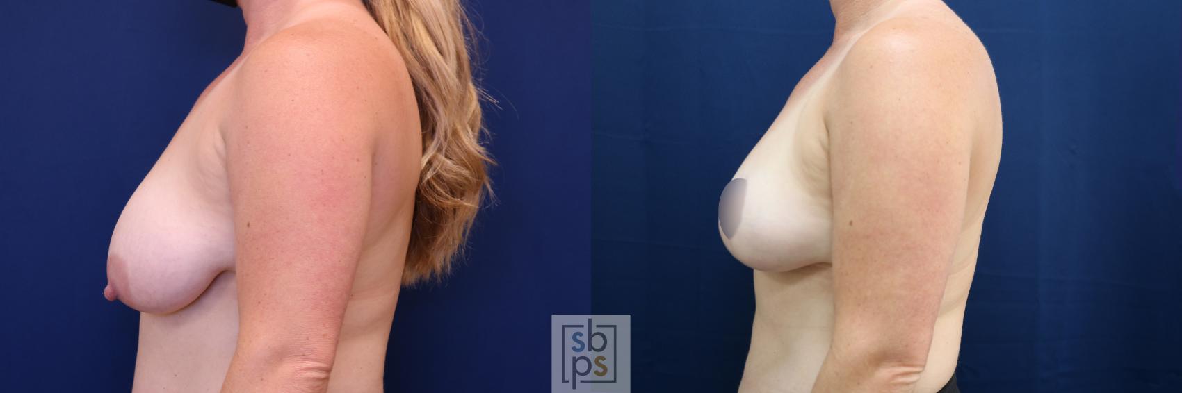 Before & After Breast Reduction Case 674 Left Side View in Los Angeles & Torrance, CA, CA