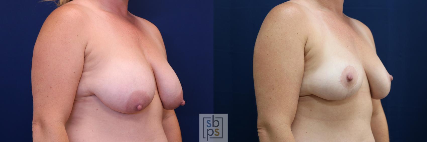 Before & After Breast Reduction Case 674 Right Oblique View in Los Angeles & Torrance, CA, CA