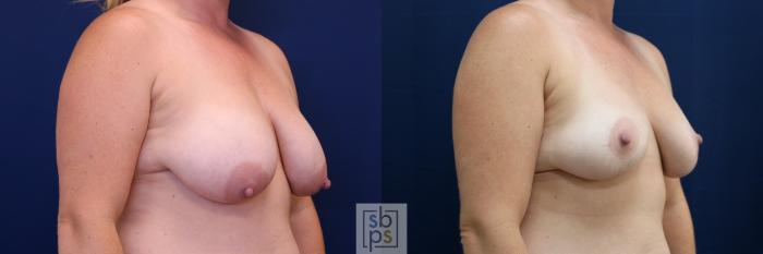 Before & After Breast Reduction Case 674 Right Oblique View in Torrance, CA