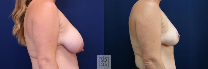 Before & After Breast Reduction Case 674 Right Side View in Torrance, CA