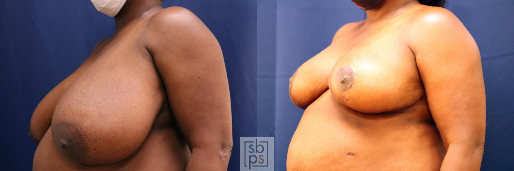 Before & After Breast Reduction Case 680 Left Oblique View in Torrance & Los Angeles, CA, CA