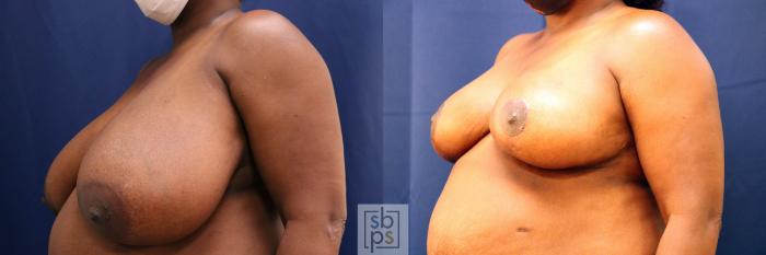 Before & After Breast Reduction Case 680 Left Oblique View in Torrance, CA
