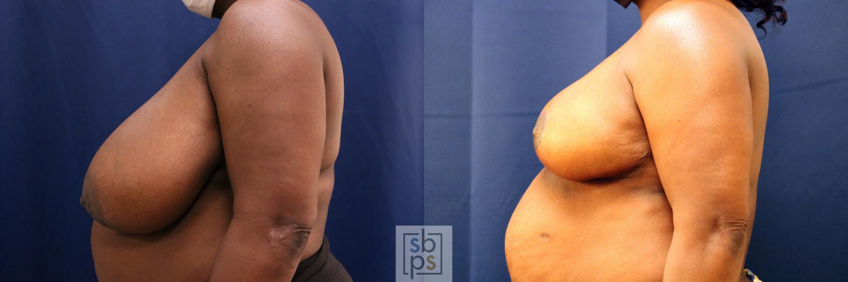Before & After Breast Reduction Case 680 Left Side View in Torrance & Los Angeles, CA, CA