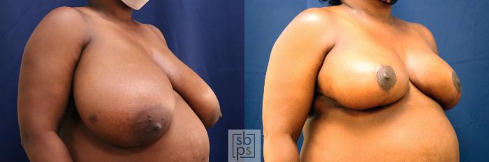 Before & After Breast Reduction Case 680 Right Oblique View in Torrance, CA
