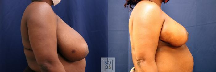 Before & After Breast Reduction Case 680 Right Side View in Torrance, CA