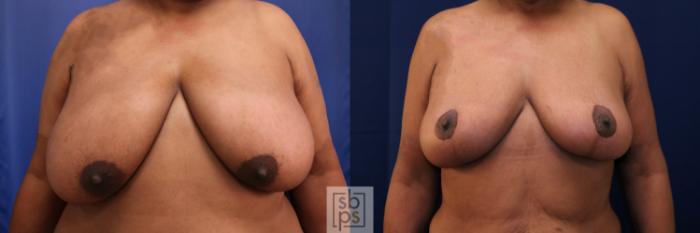 Before & After Breast Reduction Case 689 Front View in Los Angeles & Torrance, CA, CA