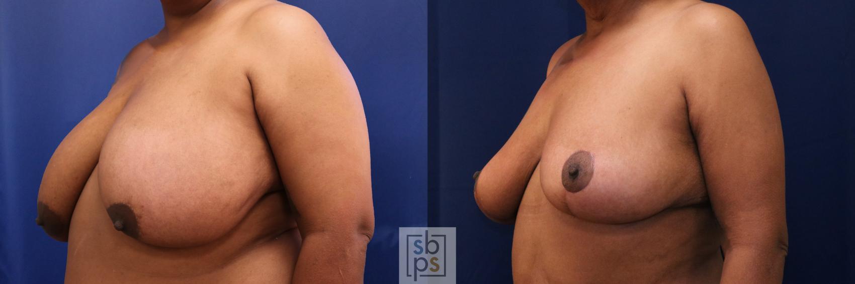Before & After Breast Reduction Case 689 Left Oblique View in Torrance & Los Angeles, CA, CA