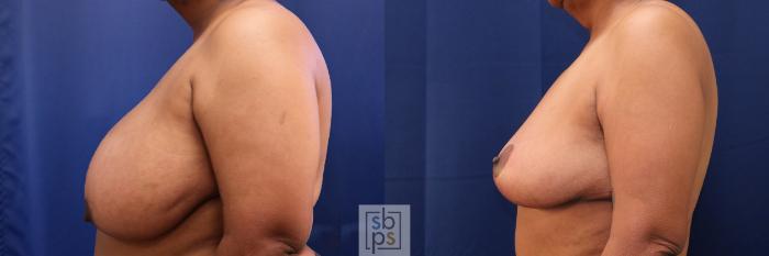 Before & After Breast Reduction Case 689 Left Side View in Los Angeles & Torrance, CA, CA