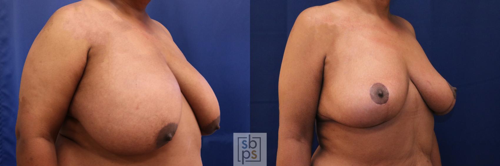 Before & After Breast Reduction Case 689 Right Oblique View in Torrance & Los Angeles, CA, CA