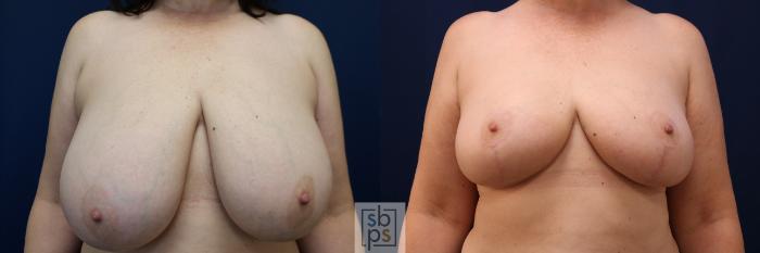 Before & After Breast Reduction Case 690 Front View in Torrance, CA