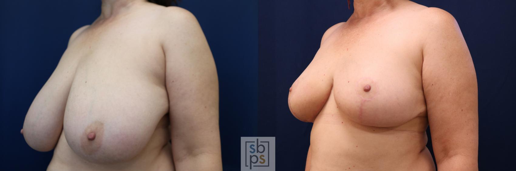 Before & After Breast Reduction Case 690 Left Oblique View in Torrance & Los Angeles, CA, CA