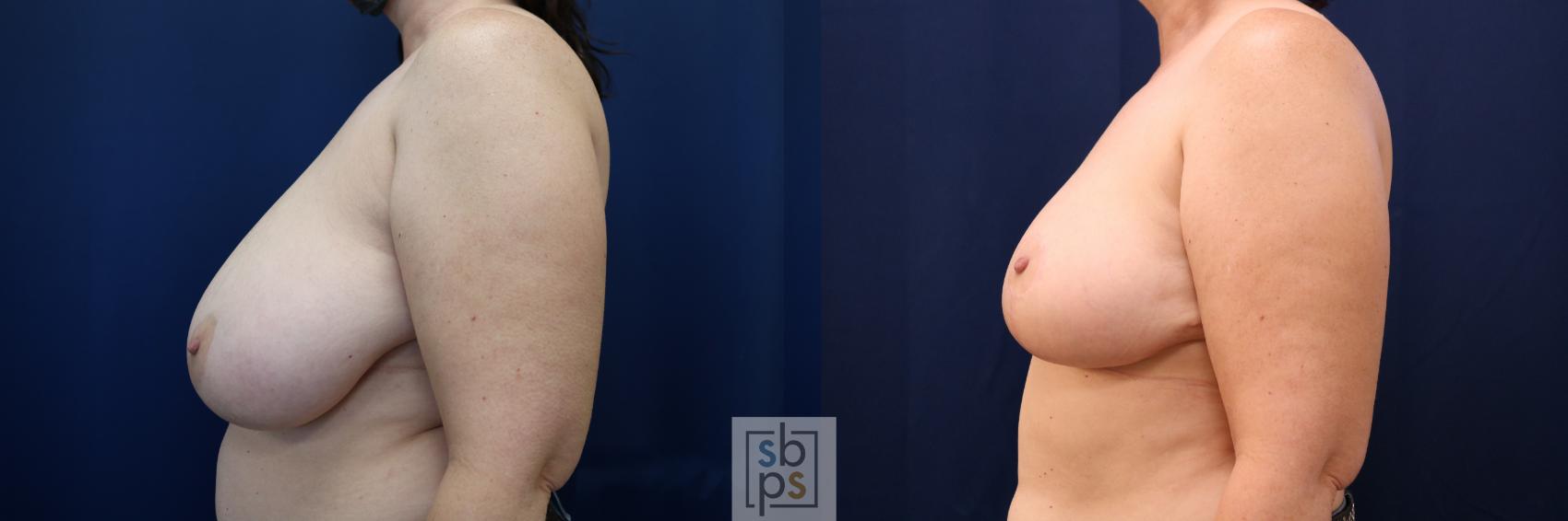 Before & After Breast Reduction Case 690 Left Side View in Torrance & Los Angeles, CA, CA