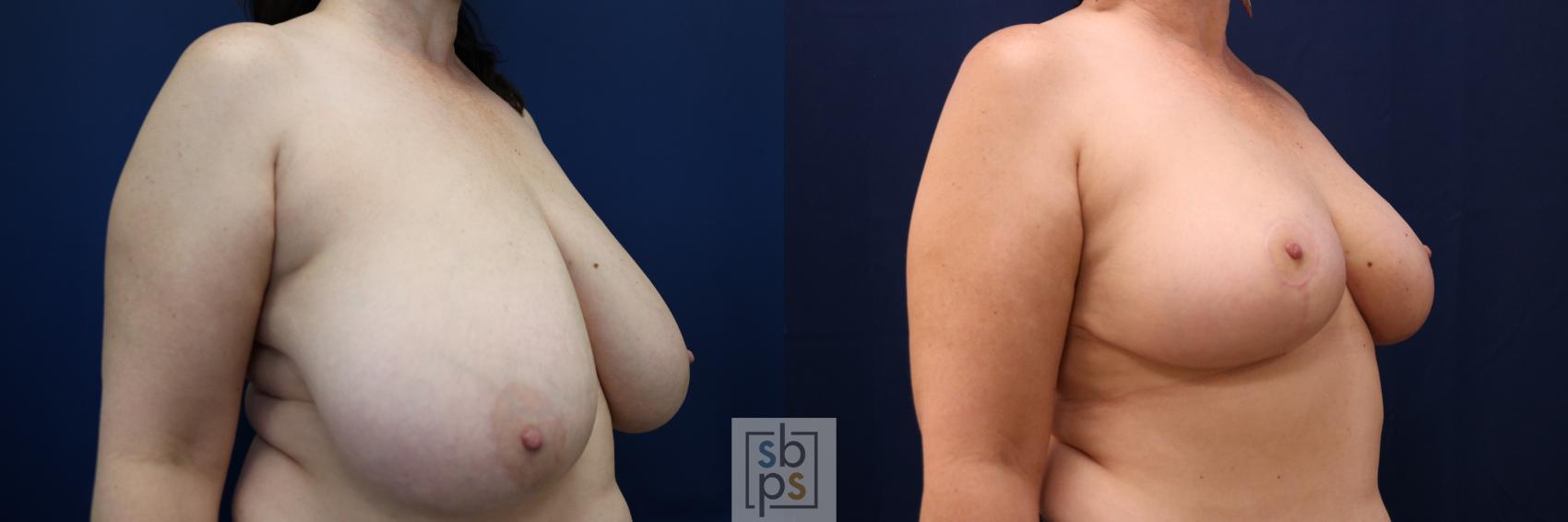 Before & After Breast Reduction Case 690 Right Oblique View in Torrance & Los Angeles, CA, CA