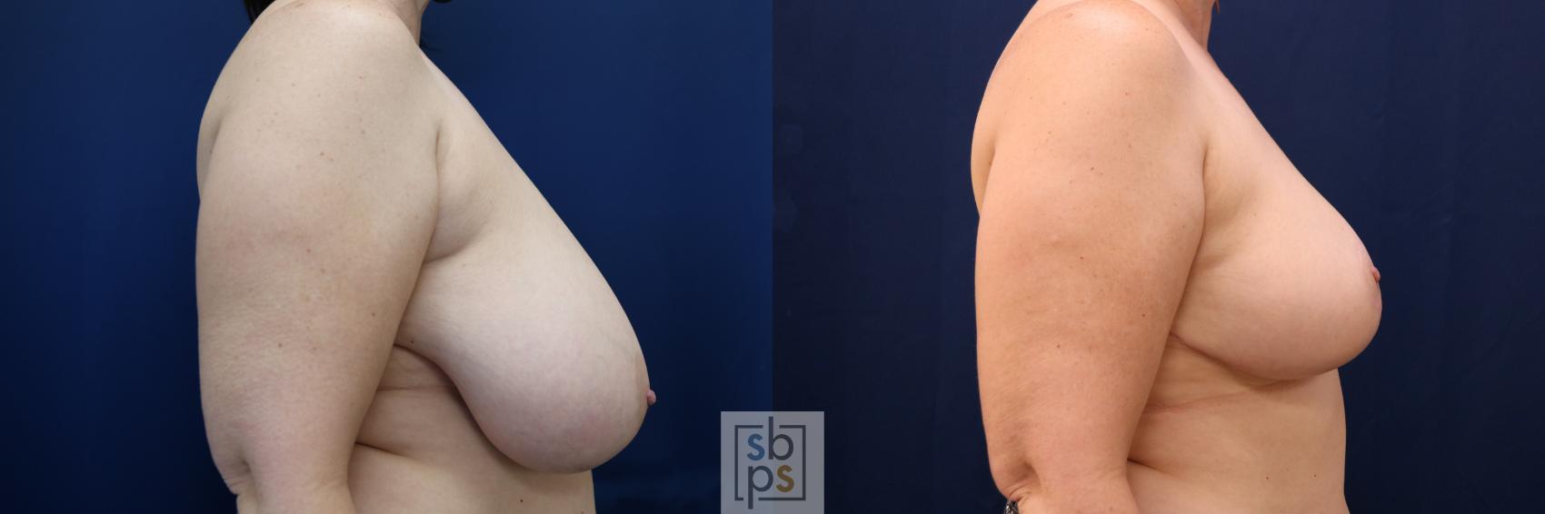 Before & After Breast Reduction Case 690 Right Side View in Torrance & Los Angeles, CA, CA