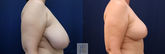 Before & After Breast Reduction Case 690 Right Side View in Torrance, CA