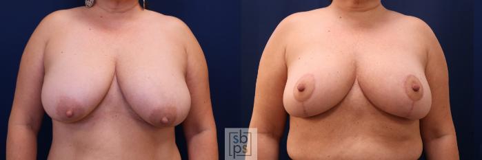 Before & After Breast Reduction Case 691 Front View in Torrance, CA