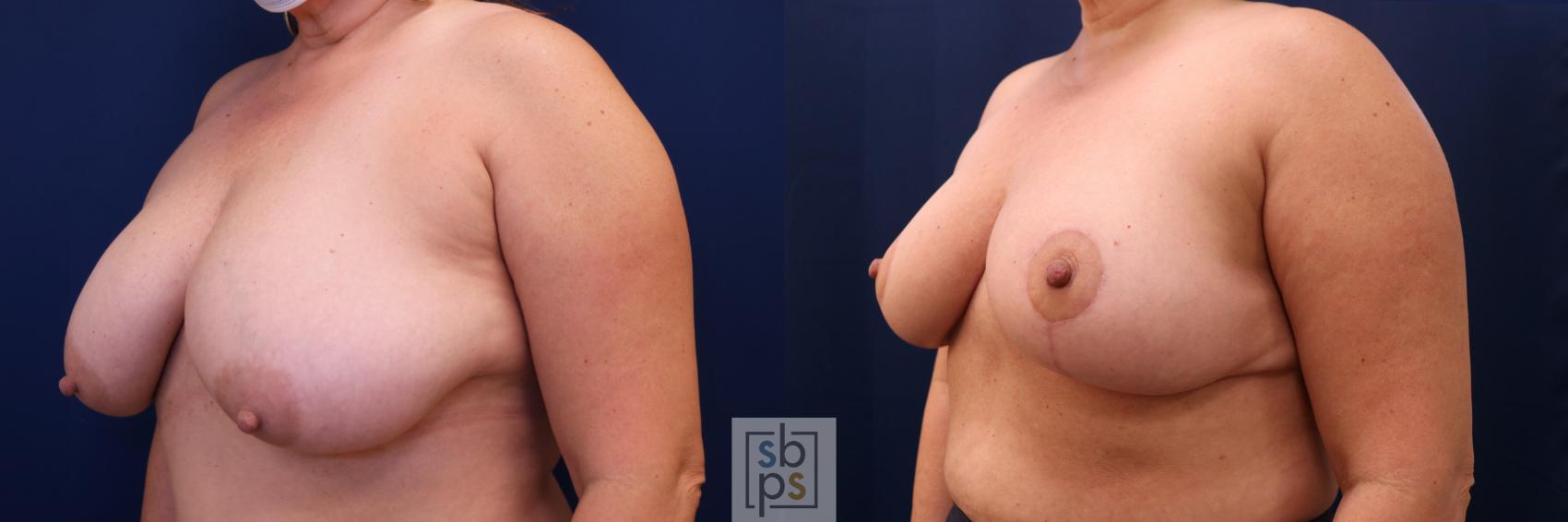 Before & After Breast Reduction Case 691 Left Oblique View in Torrance & Los Angeles, CA, CA
