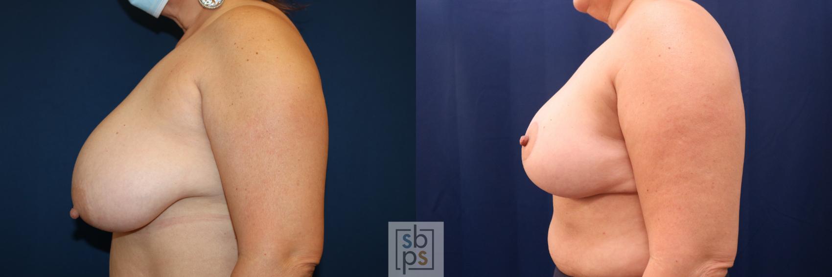 Before & After Breast Reduction Case 691 Left Side View in Torrance & Los Angeles, CA, CA
