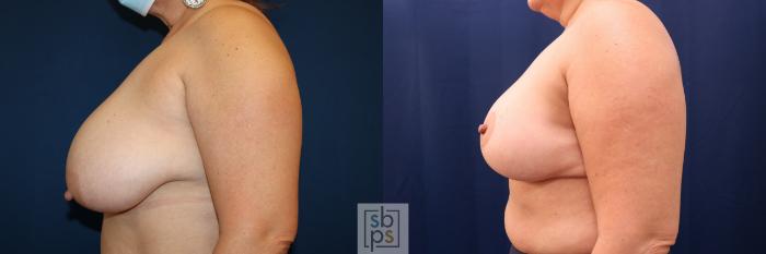Before & After Breast Reduction Case 691 Left Side View in Torrance, CA