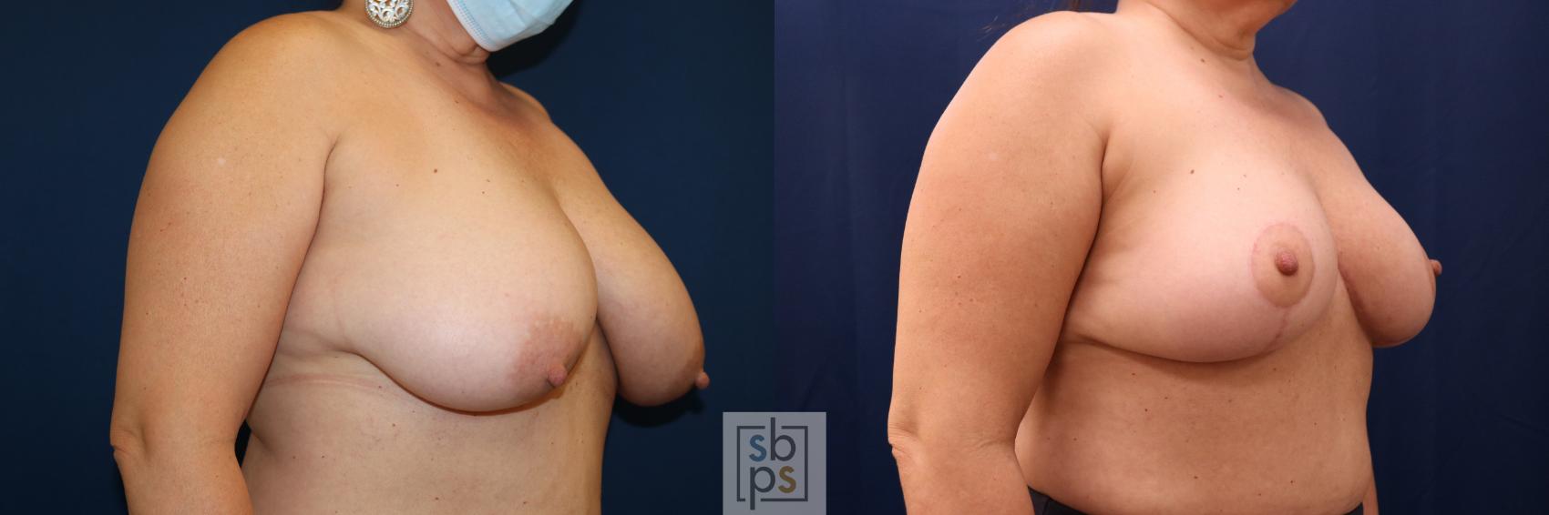 Before & After Breast Reduction Case 691 Right Oblique View in Torrance & Los Angeles, CA, CA