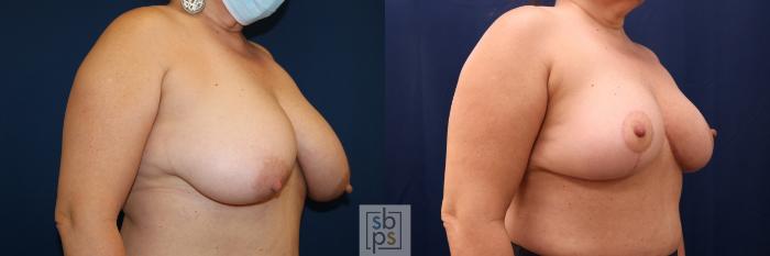 Before & After Breast Reduction Case 691 Right Oblique View in Torrance, CA