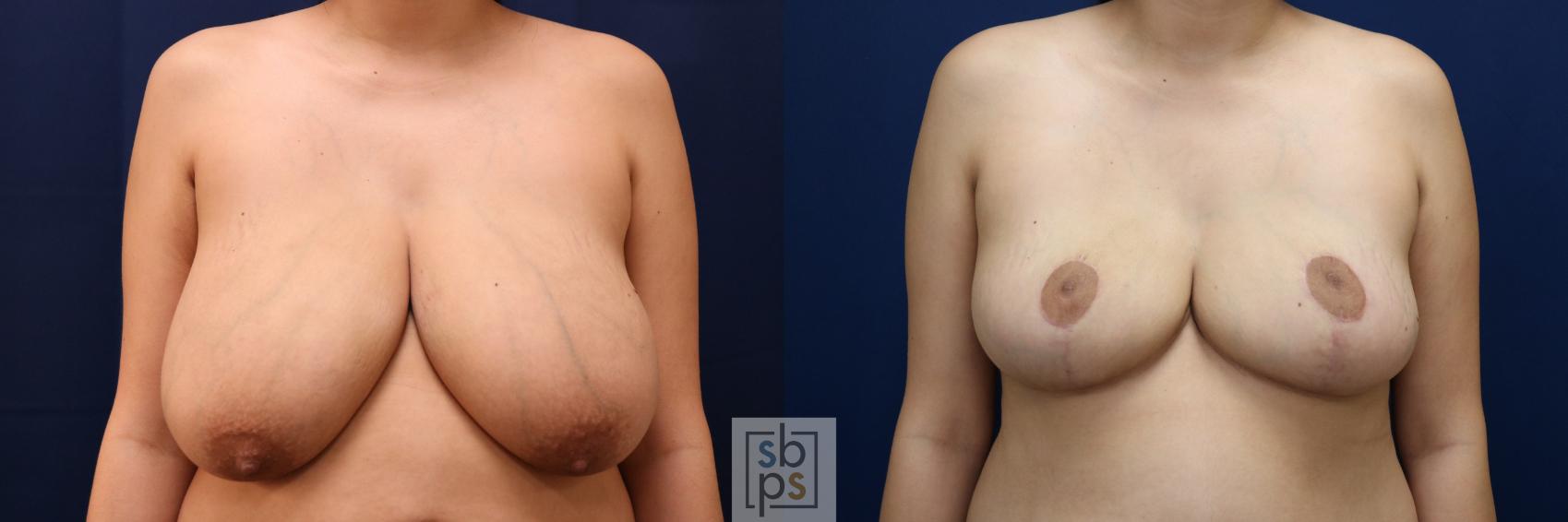 Before & After Breast Reduction Case 694 Front View in Los Angeles & Torrance, CA, CA