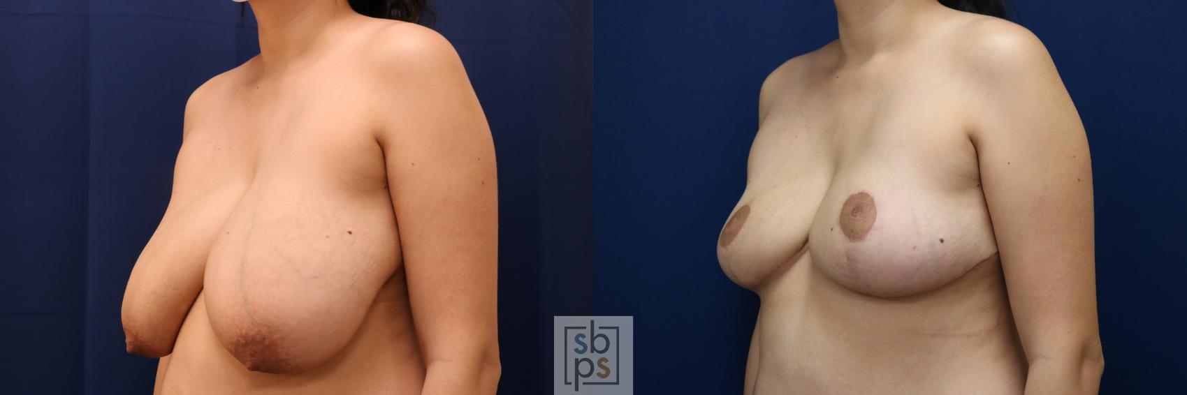 Before & After Breast Reduction Case 694 Left Oblique View in Torrance & Los Angeles, CA, CA