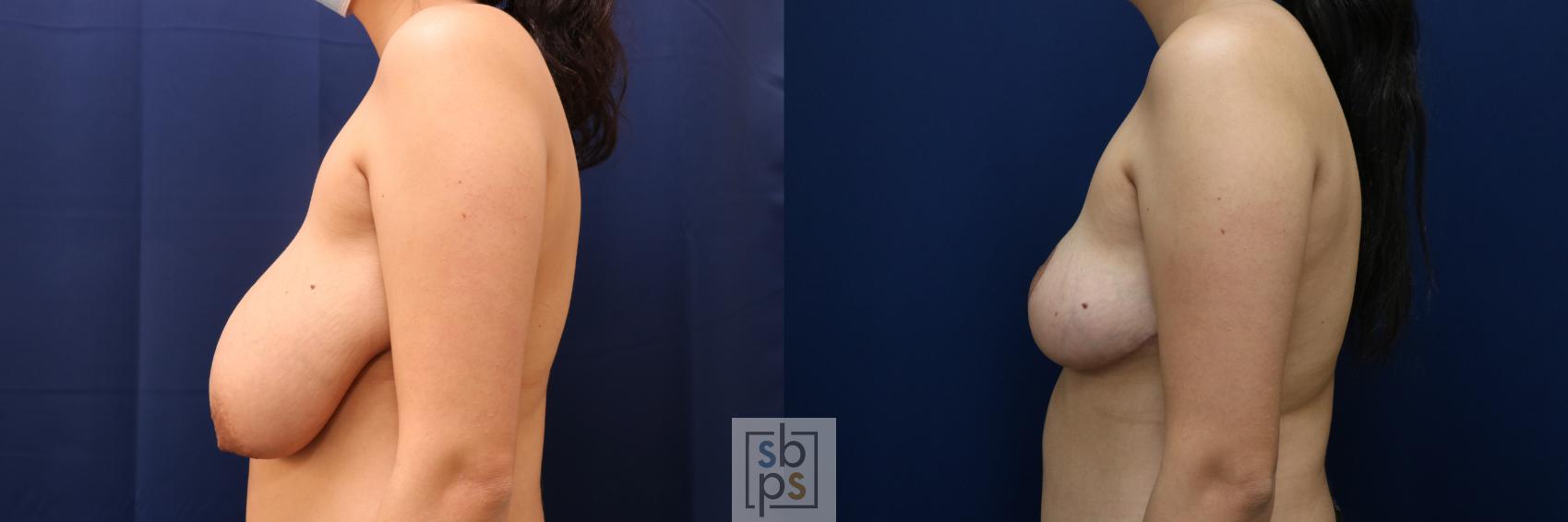 Before & After Breast Reduction Case 694 Left Side View in Torrance & Los Angeles, CA, CA