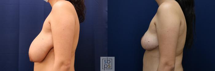 Before & After Breast Reduction Case 694 Left Side View in Los Angeles & Torrance, CA, CA